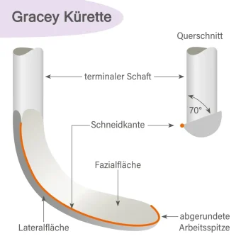 Gracey-Kürette – Schneidkante und Form für korrektes Schärfen dargestellt